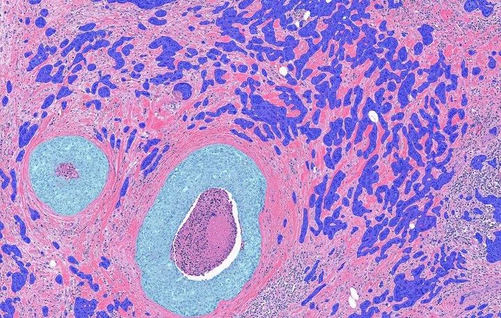 Aiforia clinical pathology image with AI-assisted tissue overlay