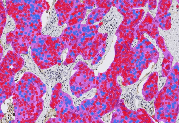 Aiforia lung PD-L1 clinical AI image with transparent cell-level overlays